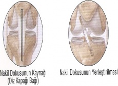 Diz Artroskopisi - Şenol Akman