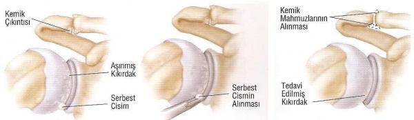 Omuz Artroskopisi - Şenol Akman